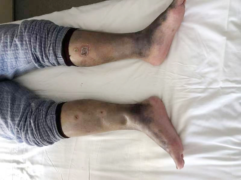 治疗前腿部水肿细节